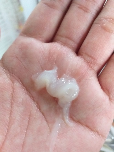 มีมูกใสๆออกแต่ไม่มีเลือด