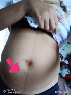 คุณแม่คนไหนเส้นเลือดขึ้นกลางท้องบ้างคะ