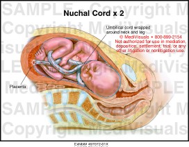 Share pengalaman bersalin baby ada nuchal cord? (tali pusat lilit leher 2x)