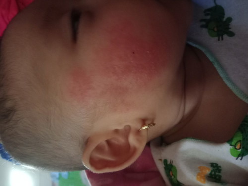 muka merah terus