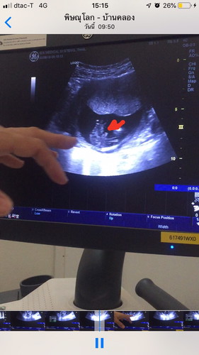 ซาวด์ 15 สัปดาห์ แม่ท่านไหนเห็นเพศลูกแล้วบ้างค่ะ