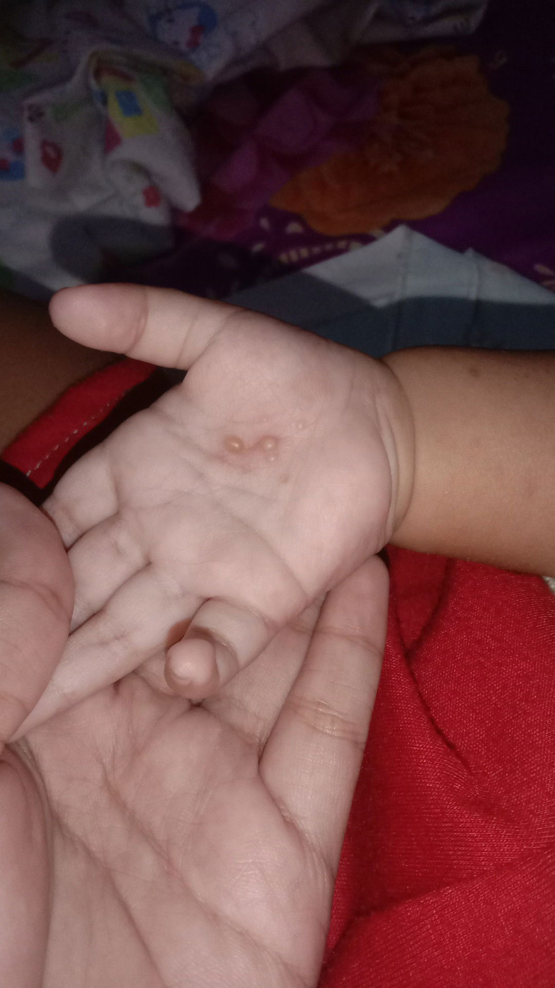 Bintik berair ditelapak kaki dan tangan