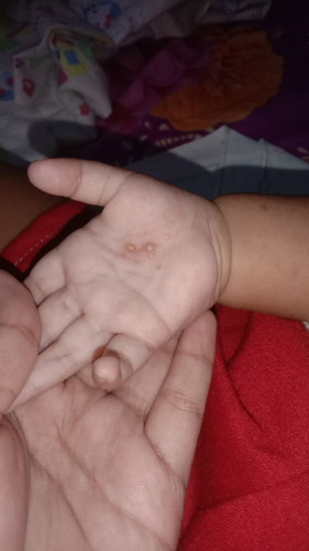Bintik berair ditelapak kaki dan tangan