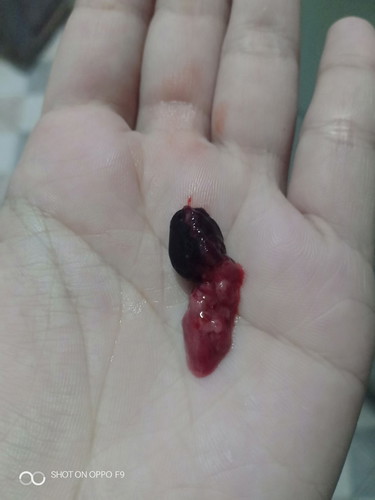 ประจำเดือนไม่มา 1 เดือน 24 วัน วันแล้วคะแม่ๆ