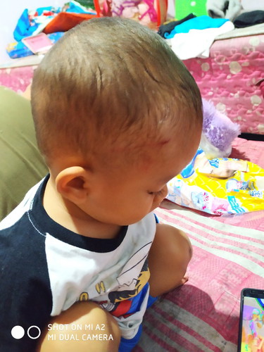 Luka dikepala bayi 1 tahun