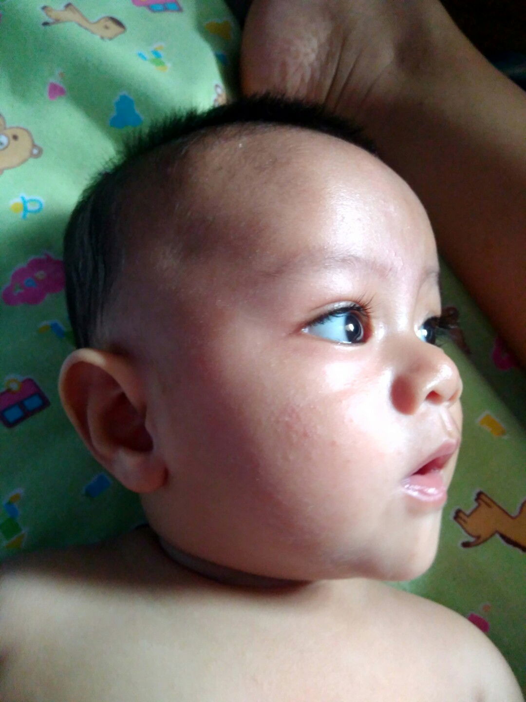 Beruntusan/biang Keringat