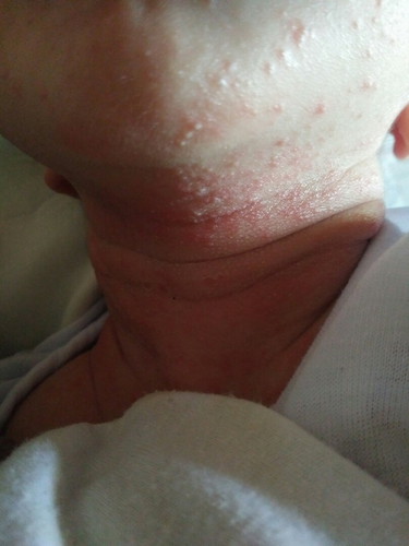 Skin Rashes?