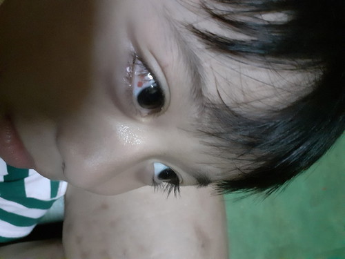 ตามีจุดแดง