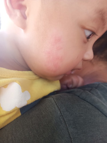 ปื้นที่แก้ม