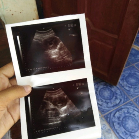 เลือดไหล ในช่องคลอด ไม่แน่ใจว่าท้องได้1เดือน รึ2