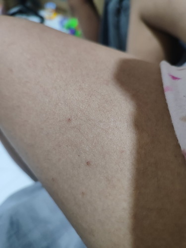 Pangangati ng Ibat ibang parte ng katawan