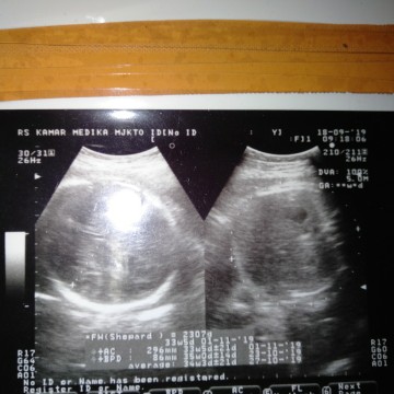 Hasil USG