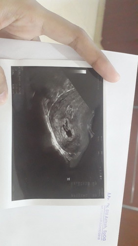 kehamilan 6minggu tidak ada detak jantung