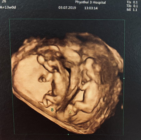 13 week.