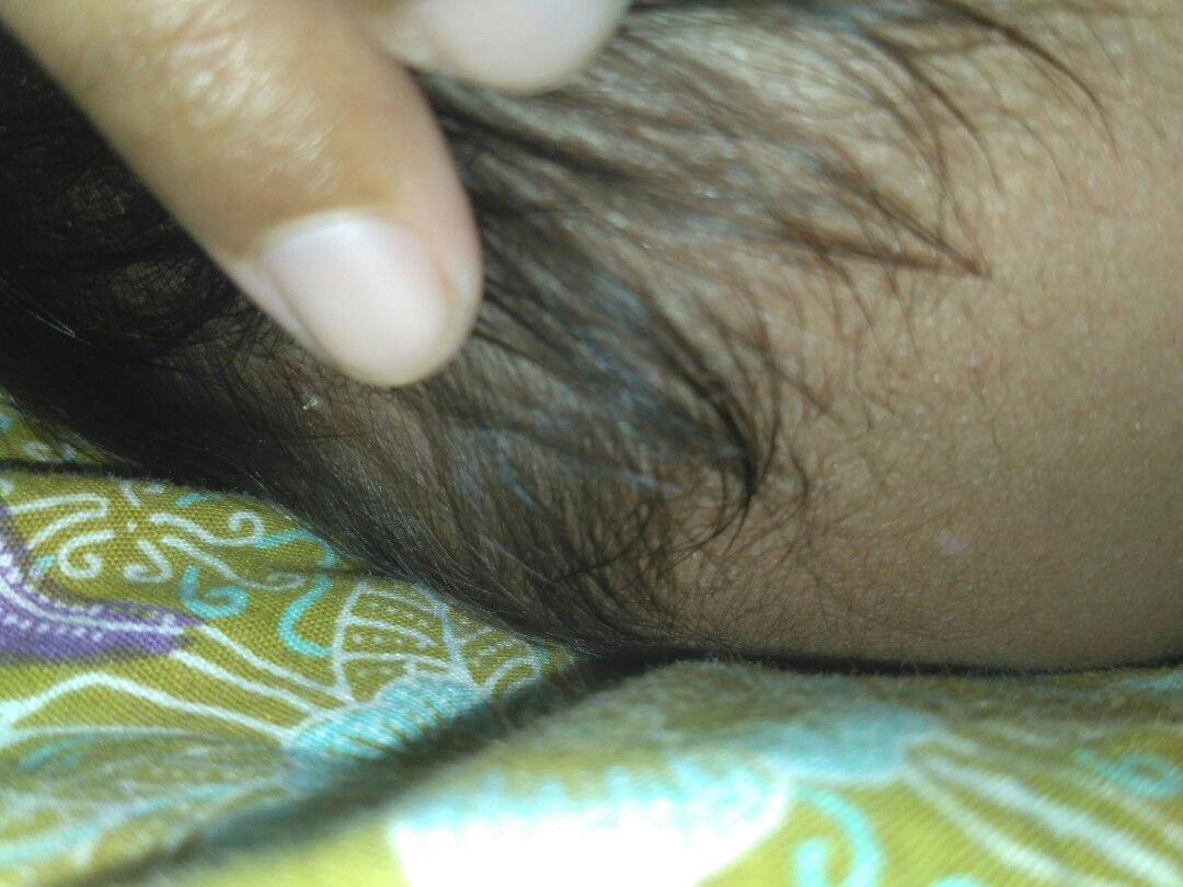 Bintik keras dikulit kepala