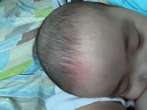 Sino po dito same case sa lo ko na kapag inis na inis or umiiyak namumula yung ganito nya?