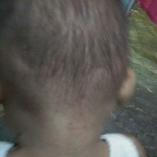 biang keringat dikepala