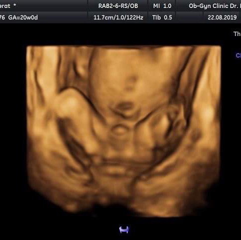 20 weeks คุณแม่อยากได้ ผญ คร่าาาา