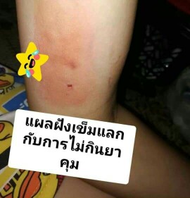 แม่ๆทุกคน คุมกำเนิดแบบใหนกันบ้างค่ะ