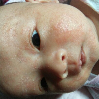 น้องเป็นผดเต็มหน้า