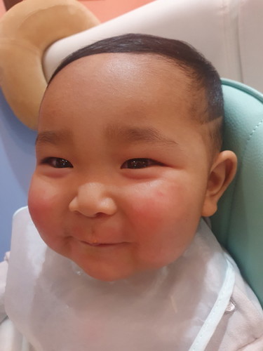 ลูกเป็นผื่น รอยแดง และหน้าแห้ง