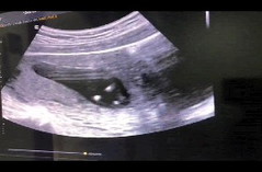 12weeks อัลตราซาวน์เห็นเพศ