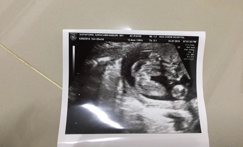 อัลตร้าซาวด์