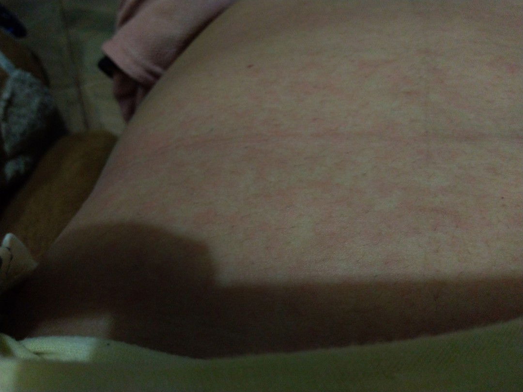 gatal gatal saat hamil