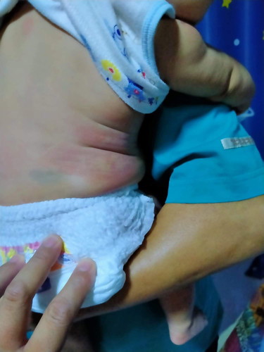 ช่วยหน่อยค่ะ น้องเป็นผื่นแบบนี้ทำอย่างไงดีดีคะ น้องร้องงอแงมาก