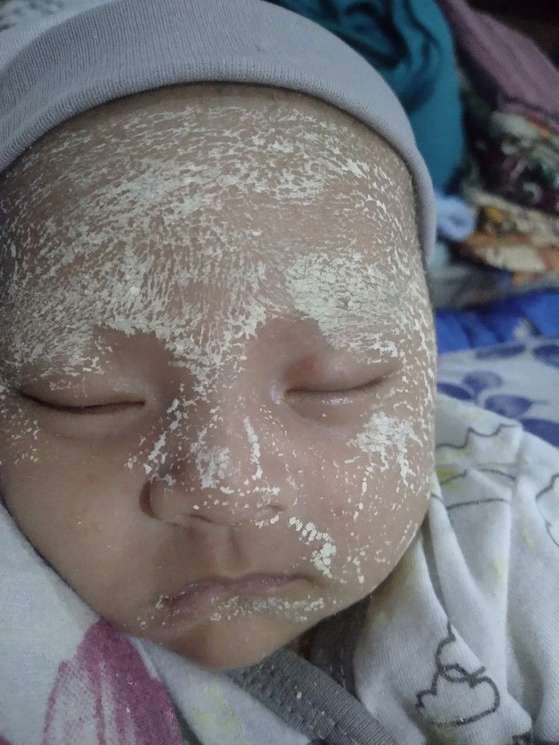 Mata bengkak sebelah