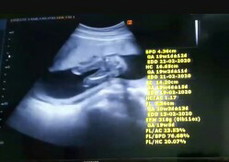 เพศลูก