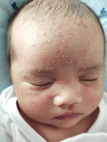 Butlig sa face ni Baby