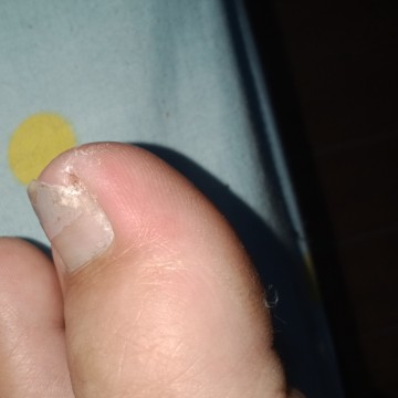 What to do?  ingrown