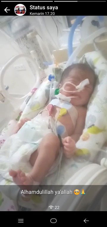 lahir prematur 33minggu