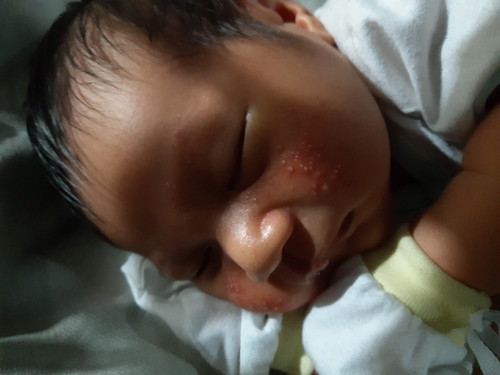 rashes s mukaa ng baby