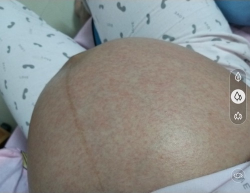 ผื่นขึ้นท้อง