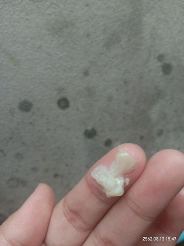 ตกขาวมีกลิ่น