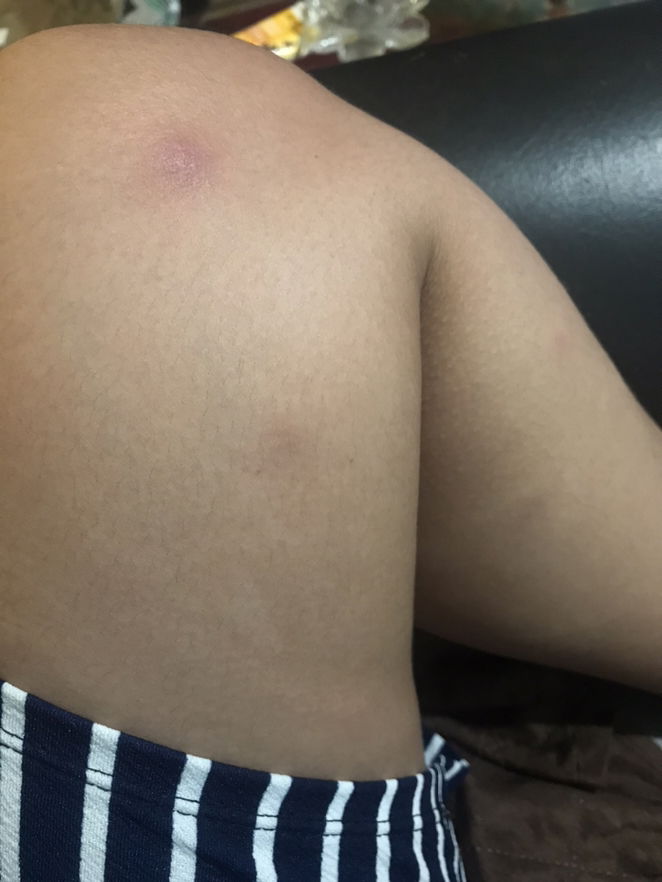 Red bumps sa mga binti