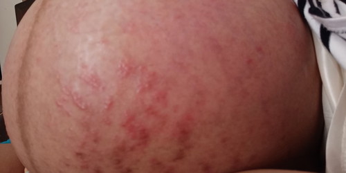 stretch marks.