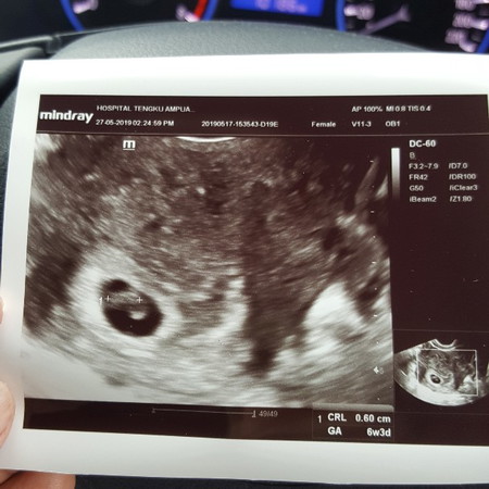 Baby IVF
