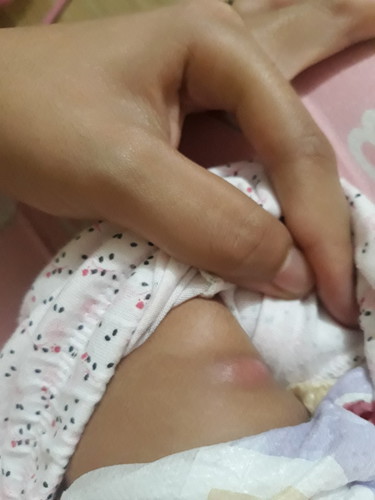 mga momsh, ask ko lang if nagkaganyan ba anak nyo after her first shots of immunization?
