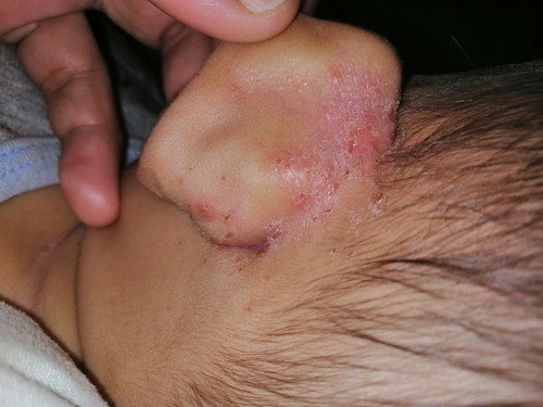 baby rashes