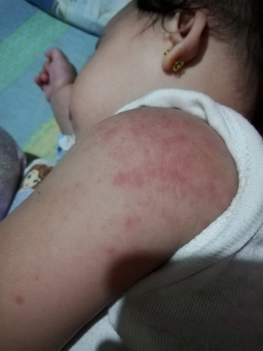 rashes