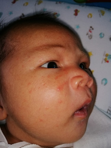 ทำไงให้ตุ่มหายค่ะ