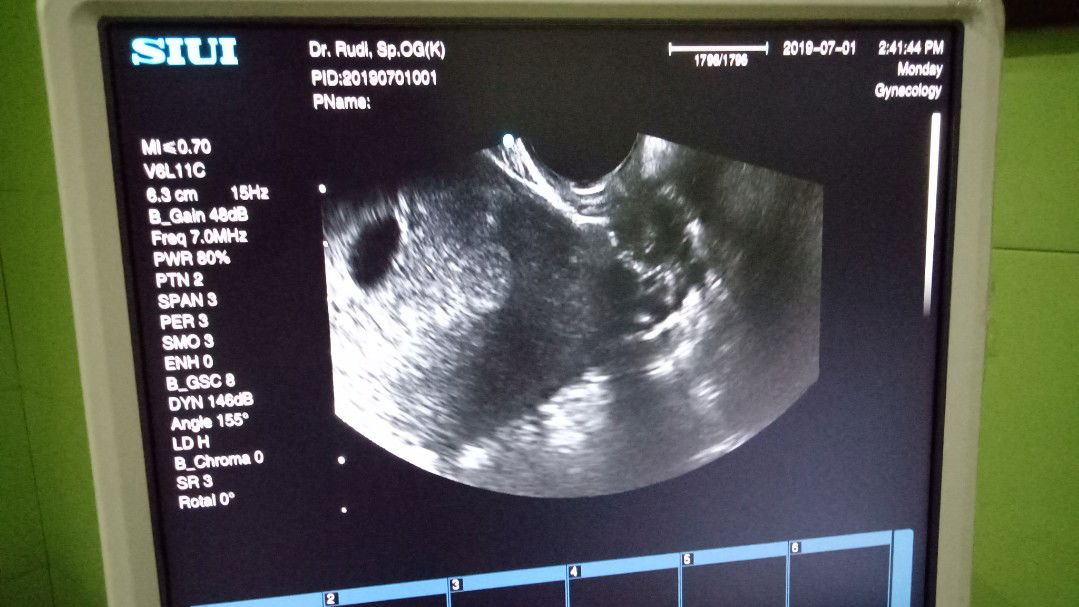 flek coklat dokter vonis BO