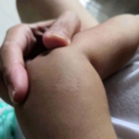Dry Skin