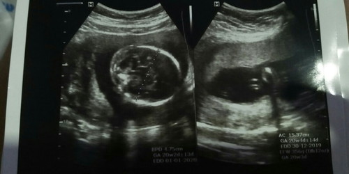 air ketuban banyak,baik/tidak?