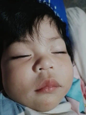 ผื่นแพ้น้ำลายไม่หาย