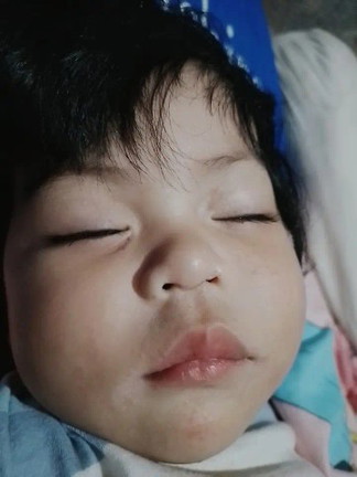 ผื่นแพ้น้ำลายไม่หาย