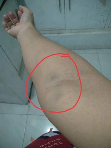 injection